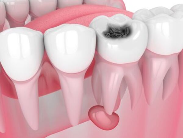 What You Need to Know About Dental Cavities