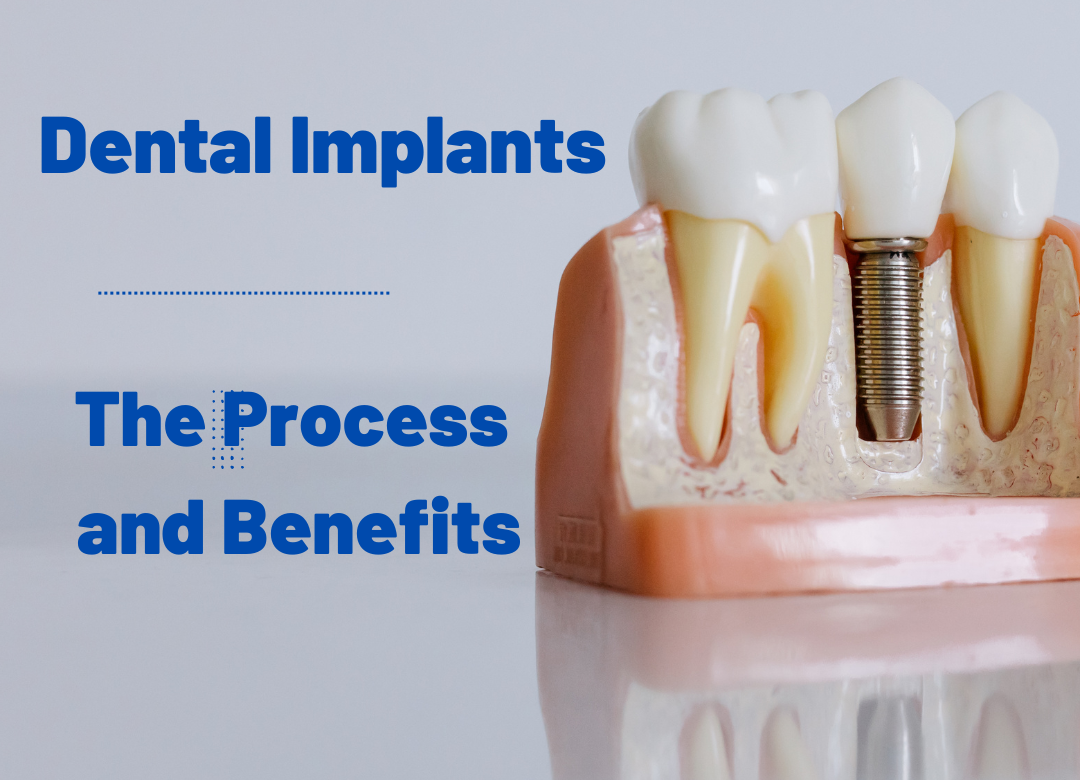 Dental Implants – The Process and Benefits